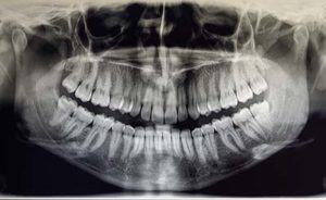 an example of Dental X-Rays