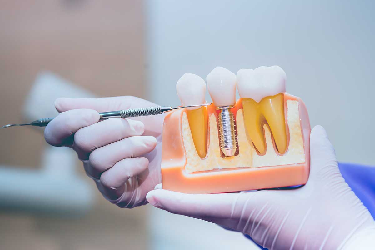 a dentist holds a model of dental implants