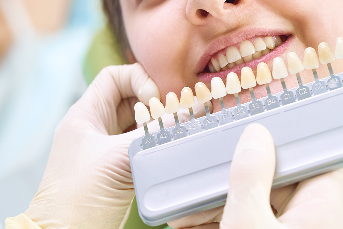 teeth whitening options dental veneer Teeth Whitening Options being compared