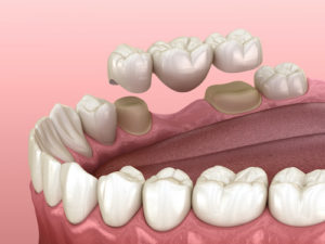 the function of dental crowns and bridges