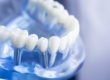 a model of teeth symbolizes a dental implant