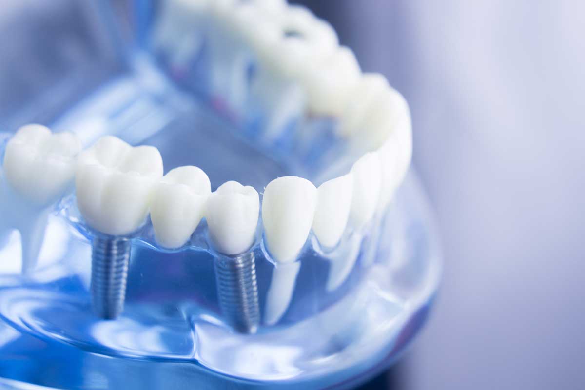 4-Benefits-of-Dental-Implants a model of teeth symbolizes a dental implant