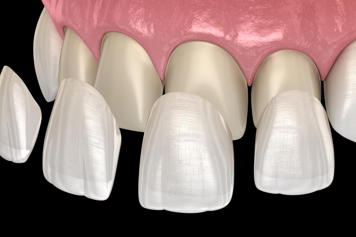 dental veneers