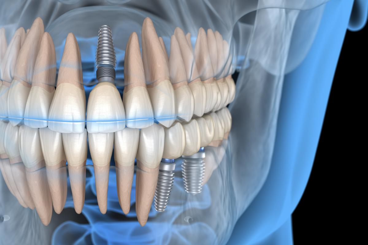 Dental Implant X-Ray